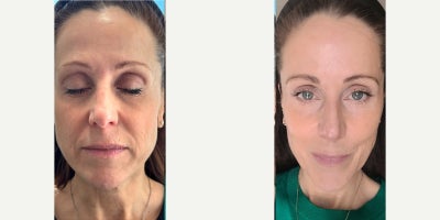 35-44 year old woman treated with Microneedling, PRP Injections - This patient achieved a beautiful, completely natural rejuvenation following a Vampire Facial treatment combining microneedling with Platelet-Rich Plasma. The before and after images reveal structurally firmer skin with a noticeable reduction in lower-face sagging and softer lines around the mouth. Additionally, the deep-cleansing collagen boost successfully eliminated surface dullness to reveal a smooth, highly radiant complexion. It stands as an excellent example of how autologous growth factors can dramatically refresh and tighten the skin without the need for invasive surgery.