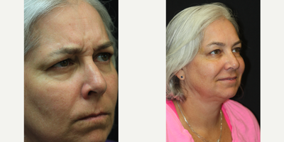 50 year old woman treated with Botox for Migraines - 50 year old woman seeking to address early signs of aging consulted with Dr. Kris Reddy FACS. Dr. Reddy performed Botox about 40 units and dermal fillers (1 syringe of Juvederm Ultra in the nasolabial folds and perioral lines and 1 syringe of Voluma for the lower face and chin area). Patient wanted to have Botox performed for cosmetic reasons and to treat migraine headaches.