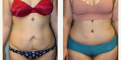 35-44 year old woman treated with Tummy Tuck - Tummy tuck surgery