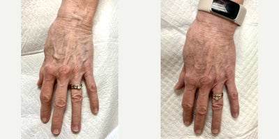 65-74 year old woman treated with Sclerotherapy to hands - 2 treatments of sclerotherapy to the veins in hands.