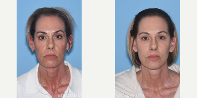 Woman treated with Deep Plane Facelift - Woman treated with Deep Plane Facelift