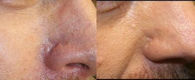 Scar treated with eMatrix - 
	Scar on male nose treated with eMatrix
