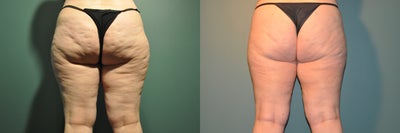 Cellulaze - 
	This patient underwent Cellulaze on her bilateral anterior (front) thighs, bilateral lateral (outer) thighs, bilateral posterior (back) thighs, and bilateral buttock.
