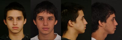 Septoplasty with nose reshaping - 
	This is a young man who had a deviated septum, large turbinates with allergies, a broken nose who underwent septorhinoplasty to fix all of his issues.
