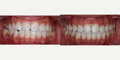 25-34 year old man treated with InBrace - Before and After of this InBrace patient after 16 months of treatment. Adjusted their narrow upper arch and crossbite as well as some crowding.