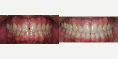 45-54 year old man treated with InBrace - This patient's crowding was addressed in just under 12 months using InBrace on both upper and lower arches.