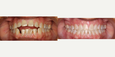 25-34 year old woman treated with InBrace - This patient had a strong open bite which was entirely adjusted along with spacing in just 15 months.