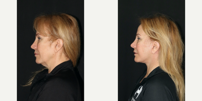 45-54 year old woman treated with Facelift - This patient wanted a noticeable improvement in her jawline, neck and cheeks, but did not want to look like she had a facelift. She wanted to look like herself, just refreshed. I performed a facelift and neck lift on her. At 7 weeks, she has a little swelling and and her scars are barely visible. They will continue to fade over the next few weeks as will the small amount of swelling.