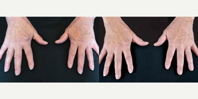 65-74 year old woman treated with Radiesse - 69 year old woman treated with Radiesse to both hands to improve appearance of veins