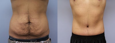 Tummy tuck for a male - 
	Patient had lost a significant amount of weight and had excess skin on the abdomen that were stretched beyond the point of recoiling back the way that he would like. Patient is extremely happy with his results.
