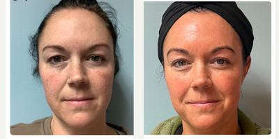 35-44 year old woman treated with Opus Plasma - This client was unhappy with her fine lines and uneven texture along with some pigmentation concerns. Opus plasma combined with the Harmony Dye VL was used to help address many areas of concern.
