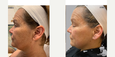 55-64 year old woman treated with Microneedling, Skin Rejuvenation, Vampire Facelift, Vampire Facial, Skin Tightening - 55 year old female with severe sun damage and deep wrinkling. 3 Microneedling with prp sessions were done 1 month apart.