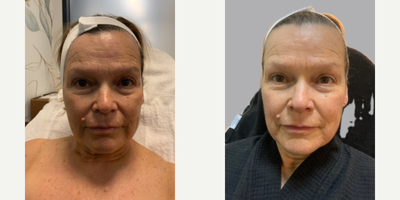 55-64 year old woman treated with Microneedling, Skin Rejuvenation, Vampire Facelift, Vampire Facial, Skin Tightening - 55 year old female with severe sun damage and deep wrinkling. 3 Microneedling with prp sessions were done 1 month apart.