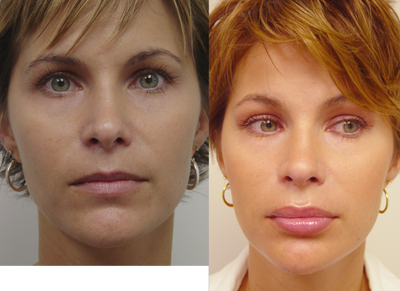 Lip Augmentation - 
	Lip Augmentation
