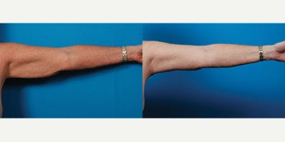 55-64 year old woman treated with Arm Lift - Procedure: Brachioplasties, liposuction of arms and axillae.