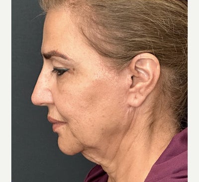 45-54 year old woman treated with Neck Lift - Neck Lift