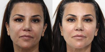 55-64 year old woman treated with Thread Lift - Patient was concerned with lower face and smile lines. Patient was treated with PDO Threads. Photos were taken 1 week post procedure.