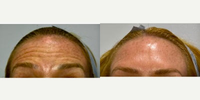 45-54 year old woman treated with Botox - 8 units of Botox to correct horizontal forehead lines