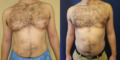 35-44 year old man treated with Gynecomastia Surgery - 40 year old male with overdevelopment of breast tissue treated via excision and liposuction. Results shown at one year.