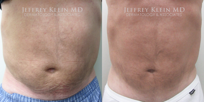 55-64 year old man treated with SculpSure - SculpSure on the Abdomen, 1 Treatment, 4PACs (4 applicators)