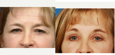 46 year old brow lift, upper and lower blepharoplasty - brow ptosis with hooding of upper lids and crepe lower lid skin