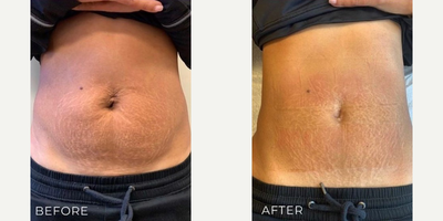 Woman treated with Evolve - Woman treated with Evolve