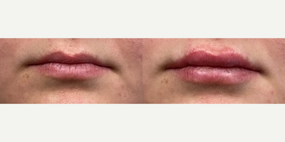 35-44 year old woman treated with Juvederm - Lip augmentation using one syringe of Juvederm