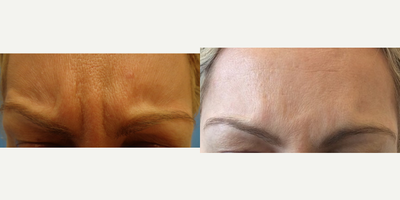 35-44 year old woman treated with Fraxel Repair - She had two separate prior reactions to Botox and wanted ThermiRase to reduce her 11, the frown lines between the eyebrows in the glabellar region of the forehead. She returned a couple of years later to retreat some small movement. Swelling is expected for a week or more after this invasive procedure, which is different than injecting Botox. ThermiRase from ThermiTight uses injectable RF energy to make the nerve unable to cause muscle contraction.