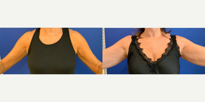 55-64 year old woman treated with Sofwave - sofwave kin tightening to the upper arms