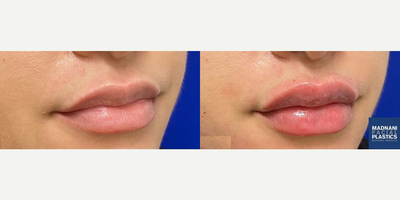 Woman treated with Restylane Kysse - Woman treated with Restylane Kysse