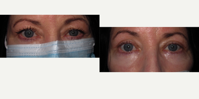 Bilateral Upper Eye Lid Blepharoplasty Surgery - Bilateral Upper Eye Lid Blepharoplasty Surgeryon 62-year-old woman