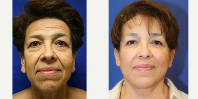 Neck Lift  (front view) - 61 year old female. She was not happy with the appearance of her face or neck. She underwent a face lift, neck lift, brow lift, upper and lower blepharoplasty and earlobe reduction.