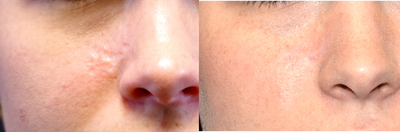 25-34 year old woman treated with Scar Removal - 28 year old female received a scar revision; photos depict the patient's results 7 months post-op.
