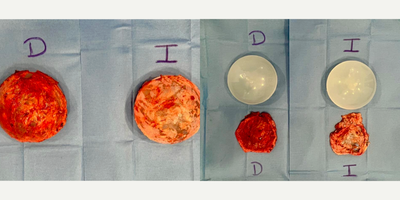 55-64 year old woman treated with Capsular Contracture Treatment, Breast Lift, Breast Implant Removal - Female patient with breast implant illnes (BII) and Asia syndrome, she had an Enbloc capsulectomy  and breast lift.