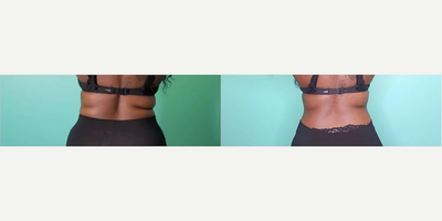Woman treated with i-Lipo - This client lost 3.5 inches and 15 lbs in 6 weeks with weekly i-Lipo and Bee Fit Injections