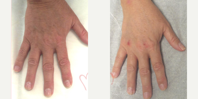 55-64 year old woman treated with Hand Rejuvenation, Radiesse, Juvederm - Hand rejuvenation with dermal filler injection (Radiesse, Juvederm) using micro-cannula technique