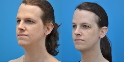 25-34 year old transgender woman treated with Facial Feminization Surgery, Transgender Facial Feminization Surgery, Brow Bone Re - This patient is a transgender female that underwent forehead reduction, brow bone reduction with sinus set back and orbital rim contouring, browlift, rhinoplasty, and shave genioplasty.