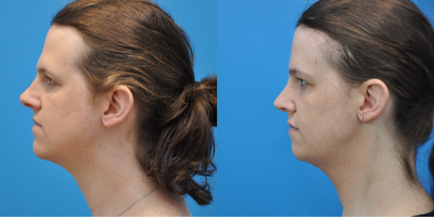 25-34 year old transgender woman treated with Facial Feminization Surgery, Transgender Facial Feminization Surgery, Brow Bone Re - This patient is a transgender female that underwent forehead reduction, brow bone reduction with sinus set back and orbital rim contouring, browlift, rhinoplasty, and shave genioplasty.