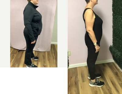 35-44 year old woman treated with Endoscopic Sleeve Gastroplasty - Our patient lost 63 Lbs in 6 months after her Endoscopic Sleeve Gastroplasty.