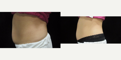 Ultrashape and Velashape - Female, treated with Ulthrashape and Velashape.