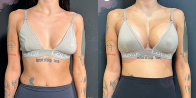 35-44 year old woman treated with Breast Implants, Breast Augmentation - 35-44 year old woman treated with Breast Implants, Breast Augmentation