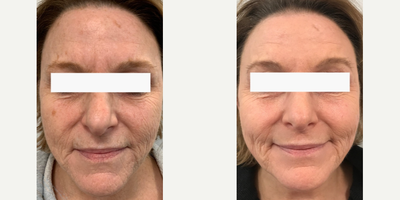 Woman treated with TotalFX - Woman treated with TotalFX