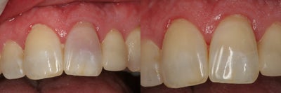 Internal Bleaching of Non-Vital Tooth - 	This patient presented after trauma to his front tooth. Root canal therapy was completed then the tooth was whitened over several visits using an internal method. The case is now over two years old and still looking great!