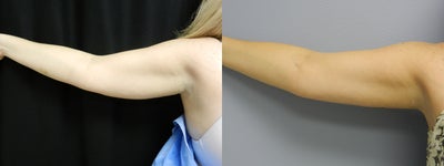 Before Laser Lipo / Arms - Patient had laser lipo procedure on arms