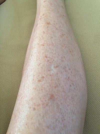 White Spots On Legs Causes