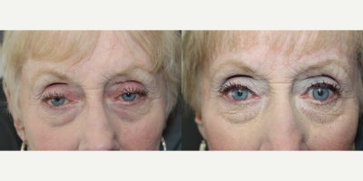 65-74 year old woman treated with Ptosis Surgery - 65-74 year old man treated with Ptosis Repair