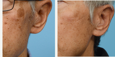 65-74 year old man treated with PicoWay - 3 sessions of PicoWay for pigmentation