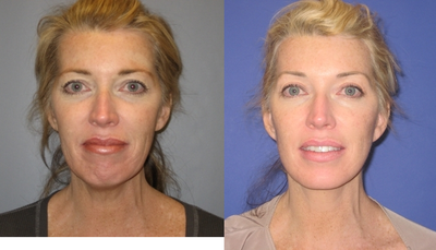 46 Year Old Woman Seeks Younger-looking Appearance - She presented to Dr. Wolfe with a desire to improve her brows, eyelids, face, and neck.  After a thorough evaluation, Dr. Wolfe performed a mini-browlift, upper and lower blepharoplasties, a Minifacelift, and tightening of her neck muscles (Platysmaplasty) with neck liposuction.  Photos were taken 7 months after her surgery.