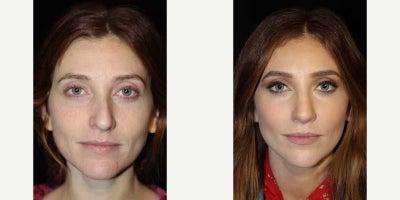 25-34 year old woman treated with Rhinoplasty, Septoplasty - Rhinoplasty, septoplasty