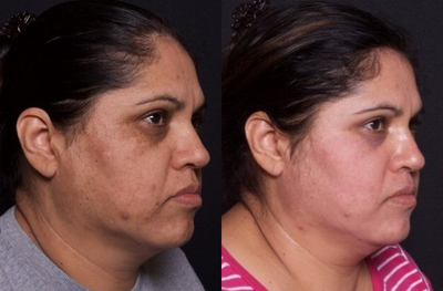 40-49 year old woman treated with Skin Rejuvenation - 40-49 year old woman treated with Skin Rejuvenation